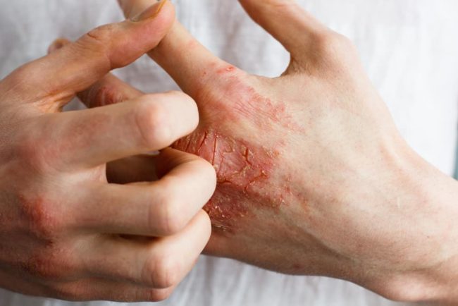 Eczema