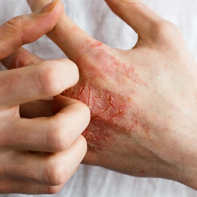 Eczema
